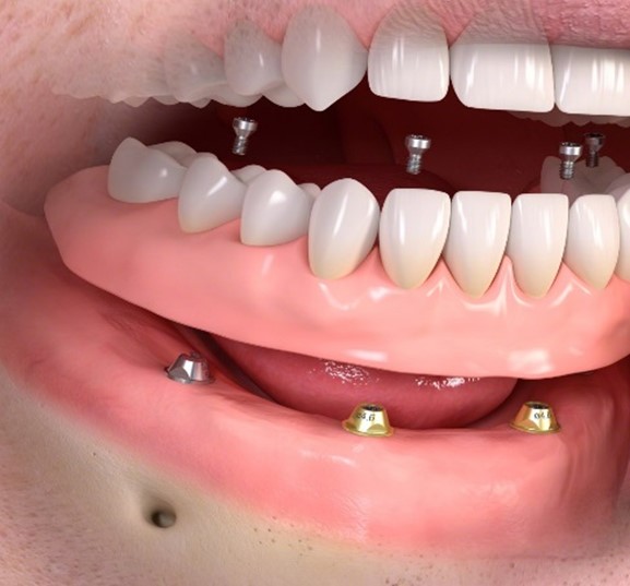 Immediate Dentures Procedure Millwood KY 42762